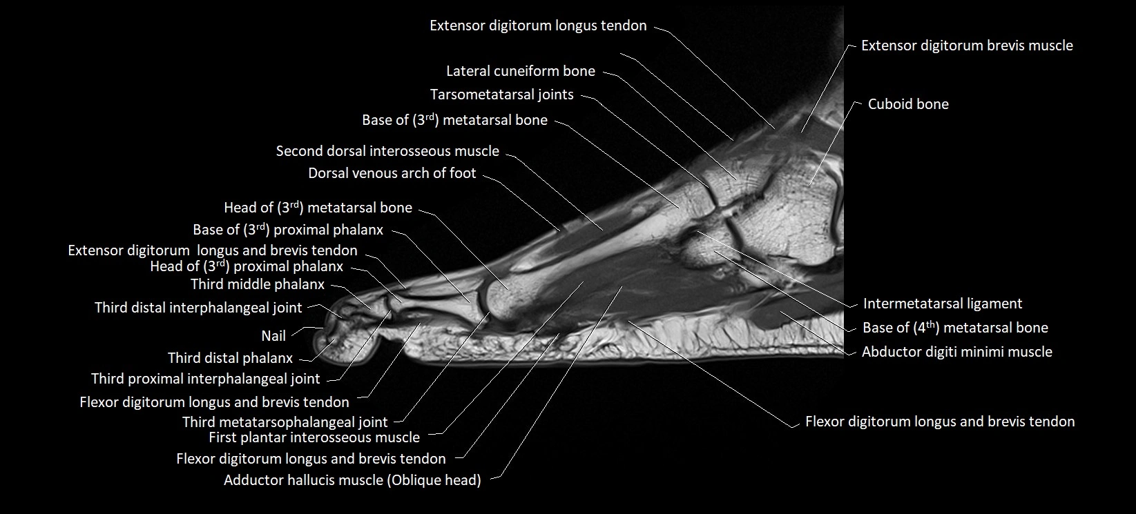 MRI foot sagittal labelled cross sectional anatomy image  17.webp